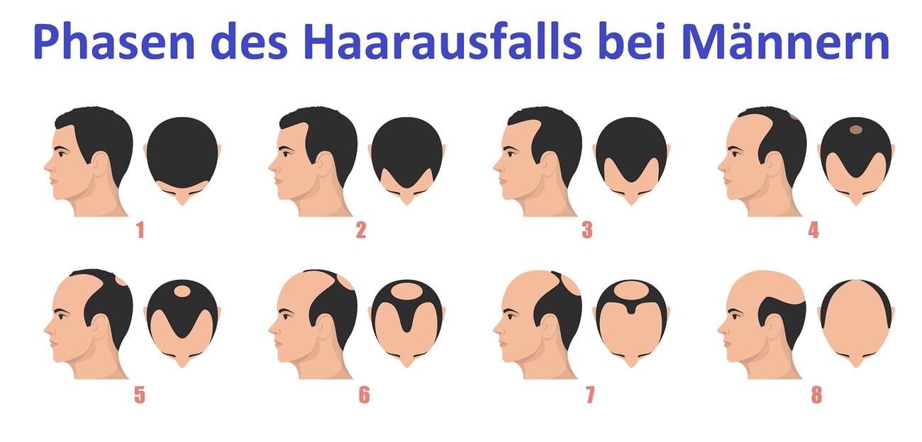 Phasen des Haarausfalls bei Männern