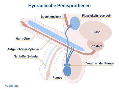  Schematische Darstellung einer hydraulischen Penisprothese