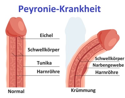 Schematische Darstellung eines normalen Penis und eines Penis mit Peyronie-Krankheit
