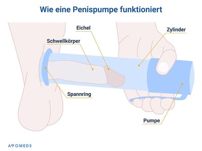 Schematische Darstellung der Funktionsweise einer Penispumpe