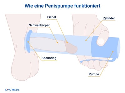 Penispumpe Anwendung