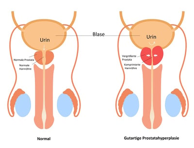 Schematische Darstellung des normalen Urogenitalsystems und der gutartigen Prostatahyperplasie